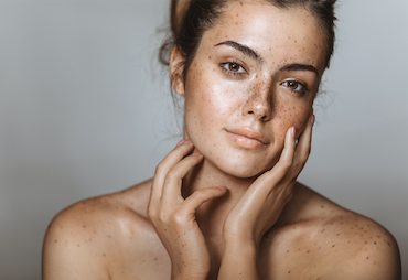 Stubborn Pigmentation and Melasma